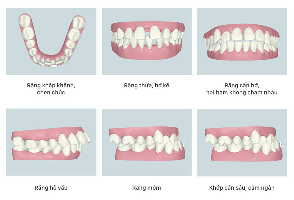 Niềng Răng