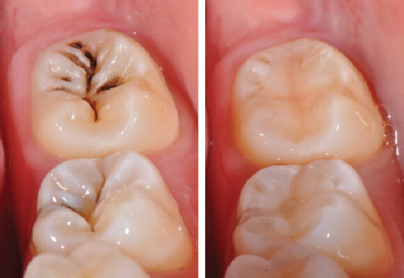 Trám răng thẩm mỹ hiệu quả tại nha khoa Westcoast