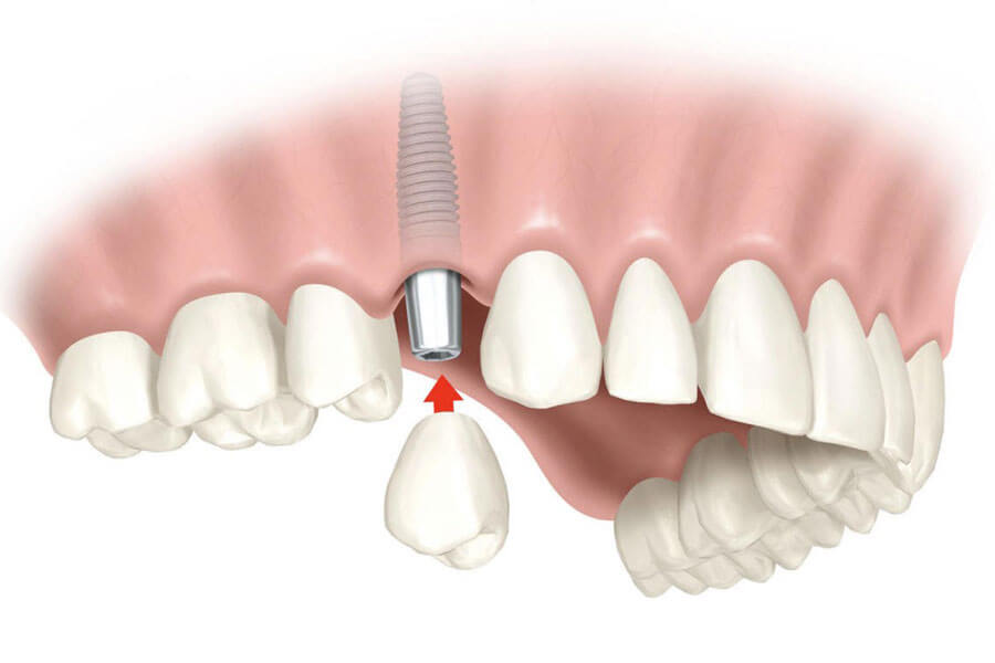 Qua Trinh Trong Rang Implant Co Dau Khong