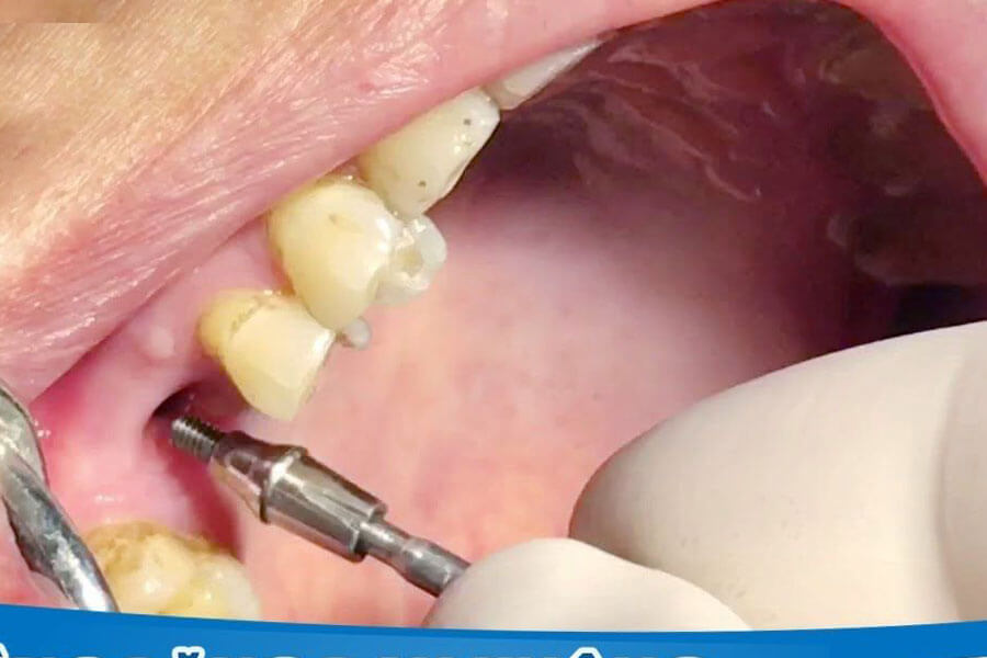 Qua Trinh Trong Rang Implant Co Dau Khong 1