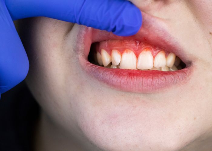 Người đang bị viêm nha chu nặng không nên trồng răng Implant