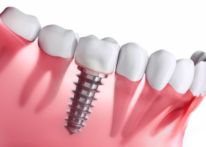 Chi phí trồng răng Implant dao động trong khoảng 141 - 176 triệu đồng