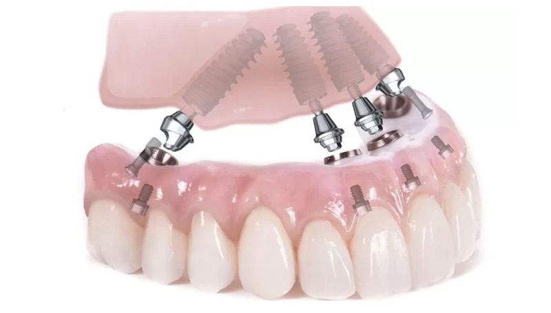 Trồng răng Implant để thay thế những răng bị mất vĩnh viễn